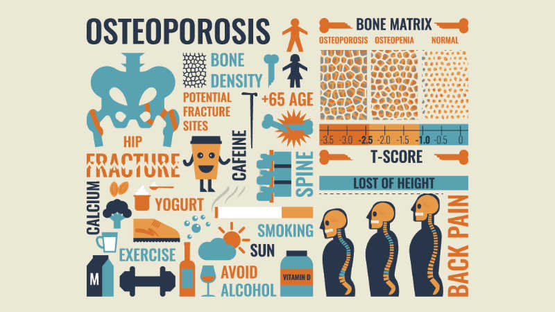 Tips to Prevent Osteoporosis